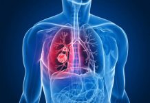 8 dấu hiệu đầu tiên của ung thư phổi
