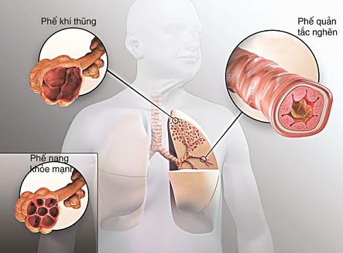 Viêm phổi là gì?